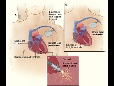 Aritmiile cardiace - tratament medicamentos sau interventional?